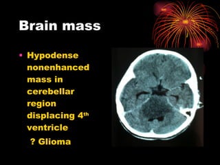 Brain mass Hypodense  nonenhanced mass in cerebellar region displacing 4 th  ventricle ? Glioma 