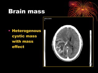 Brain mass Heterogenous cystic mass with mass effect 