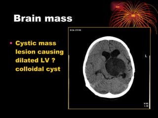 Brain mass Cystic mass lesion causing dilated LV ? colloidal cyst 
