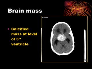 Brain mass Calcified mass at level of 3 rd  ventricle  