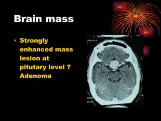 Brain mass Strongly enhanced mass lesion at pitutary level ? Adenoma  