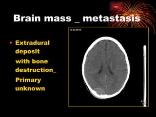 Brain mass _ metastasis Extradural deposit  with bone destruction_  Primary unknown 