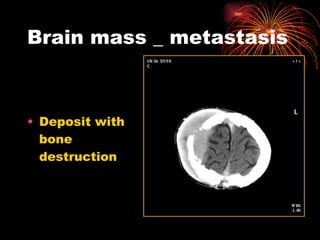 Brain mass _ metastasis Deposit with bone destruction  