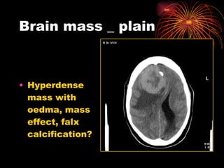 Brain mass _ plain Hyperdense mass with oedma, mass effect, falx calcification?  