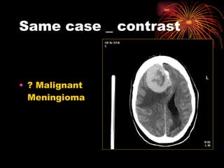 Same case _ contrast ? Malignant Meningioma 