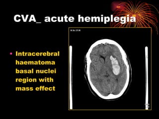 CVA_ acute hemiplegia  Intracerebral haematoma basal nuclei region with mass effect 