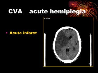 CVA _ acute hemiplegia Acute infarct 