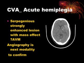 CVA_ Acute hemiplegia Serpegenious strongly enhanced lesion with mass effect ?AVM  Angiography is next modality to confirm 