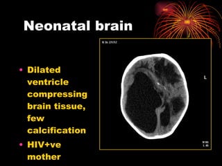 Neonatal brain  Dilated ventricle compressing  brain tissue, few calcification  HIV+ve mother ? CMV 