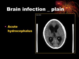 Brain infection _ plain Acute  hydrocephalus 