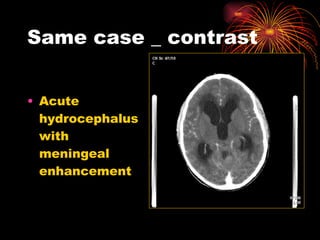 Same case _ contrast Acute hydrocephalus with meningeal enhancement 