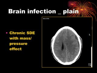 Brain infection _ plain Chronic SDE with mass/ pressure effect 