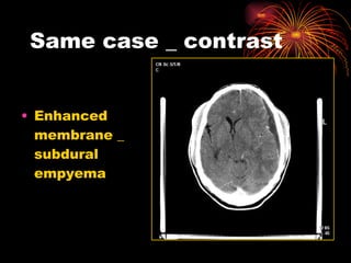 Same case _ contrast Enhanced membrane _ subdural empyema 