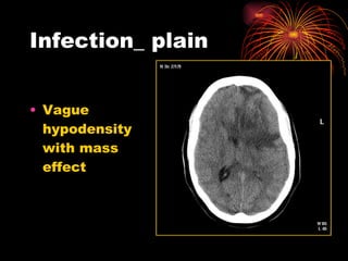 Infection_ plain Vague hypodensity with mass effect 
