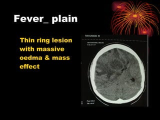 Fever_ plain Thin ring lesion with massive oedma & mass effect 