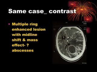 Same case_ contrast Multiple ring enhanced lesion with midline shift & mass effect- ? abscesses 