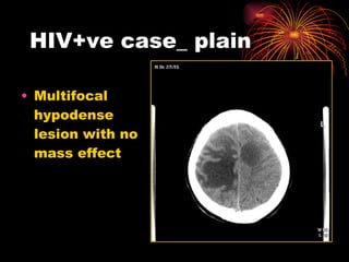 HIV+ve case_ plain Multifocal hypodense lesion with no mass effect 