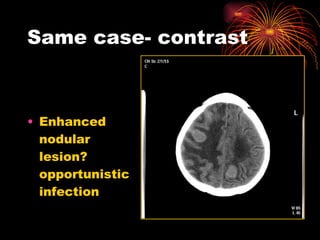 Same case- contrast Enhanced nodular lesion? opportunistic infection 