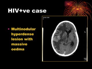 HIV+ve case Multinodular hyperdense lesion with massive oedma 