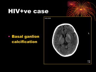 HIV+ve case Basal ganlion calcification 