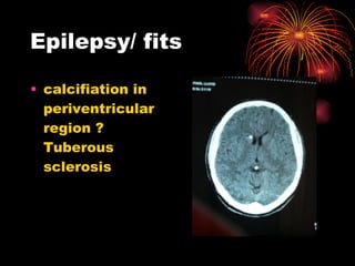 Epilepsy/ fits calcifiation in periventricular region ? Tuberous sclerosis 