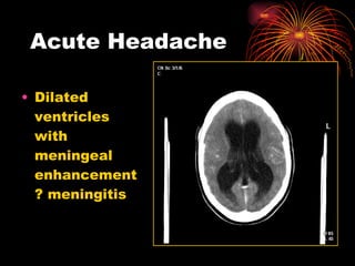 Acute Headache Dilated ventricles with meningeal enhancement ? meningitis 