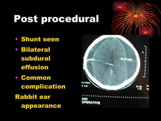 Post procedural Shunt seen Bilateral subdural effusion Common complication Rabbit ear appearance 