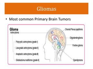 Gliomas
• Most common Primary Brain Tumors
 