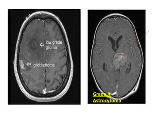Grade III
Astrocytoma
 