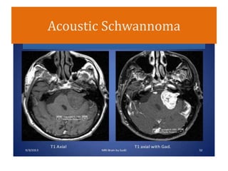 Acoustic Schwannoma
 