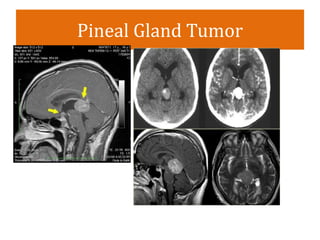 Pineal Gland Tumor
 