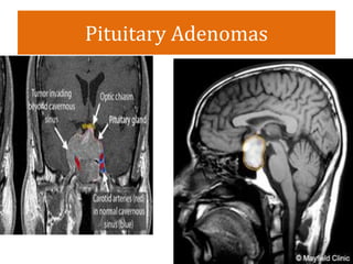 Pituitary Adenomas
 
