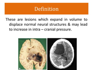 Definition
These are lesions which expand in volume to
displace normal neural structures & may lead
to increase in intra – cranial pressure.
 