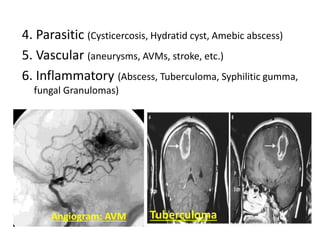 4. Parasitic (Cysticercosis, Hydratid cyst, Amebic abscess)
5. Vascular (aneurysms, AVMs, stroke, etc.)
6. Inflammatory (Abscess, Tuberculoma, Syphilitic gumma,
fungal Granulomas)
Angiogram: AVM Tuberculoma
 