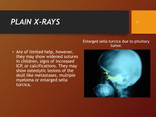 PLAIN X-RAYS
Enlarged sella turcica due to pituitary
tumor.
• Are of limited help, however,
they may show widened sutures
in children, signs of increased
ICP, or calcifications. They may
show osteolytic lesions of the
skull like metastases, multiple
myeloma or enlarged sella
turcica.
17
 