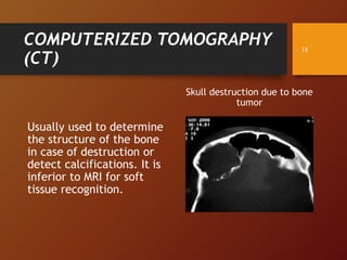 COMPUTERIZED TOMOGRAPHY
(CT)
Skull destruction due to bone
tumor
Usually used to determine
the structure of the bone
in case of destruction or
detect calcifications. It is
inferior to MRI for soft
tissue recognition.
18
 