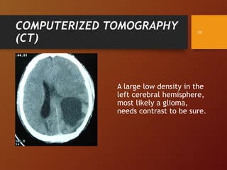 COMPUTERIZED TOMOGRAPHY
(CT)
A large low density in the
left cerebral hemisphere,
most likely a glioma,
needs contrast to be sure.
19
 