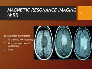 MAGNETIC RESONANCE IMAGING
(MRI)
Para sagittal meningioma
1) T1 showing low intensity
2) After the injection of
Gadolinium.
3) FLAIR
20
 