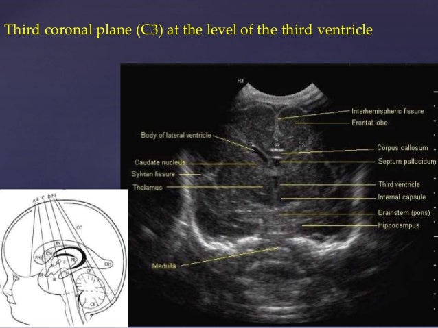 Intracranial ultrasound diagram of the occipital lobe 
