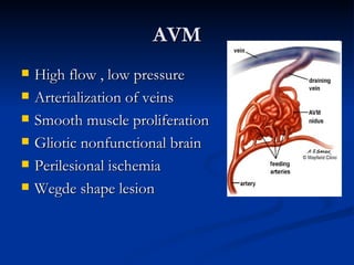 AVM
   High flow , low pressure
   Arterialization of veins
   Smooth muscle proliferation
   Gliotic nonfunctional brain
   Perilesional ischemia
   Wegde shape lesion
 