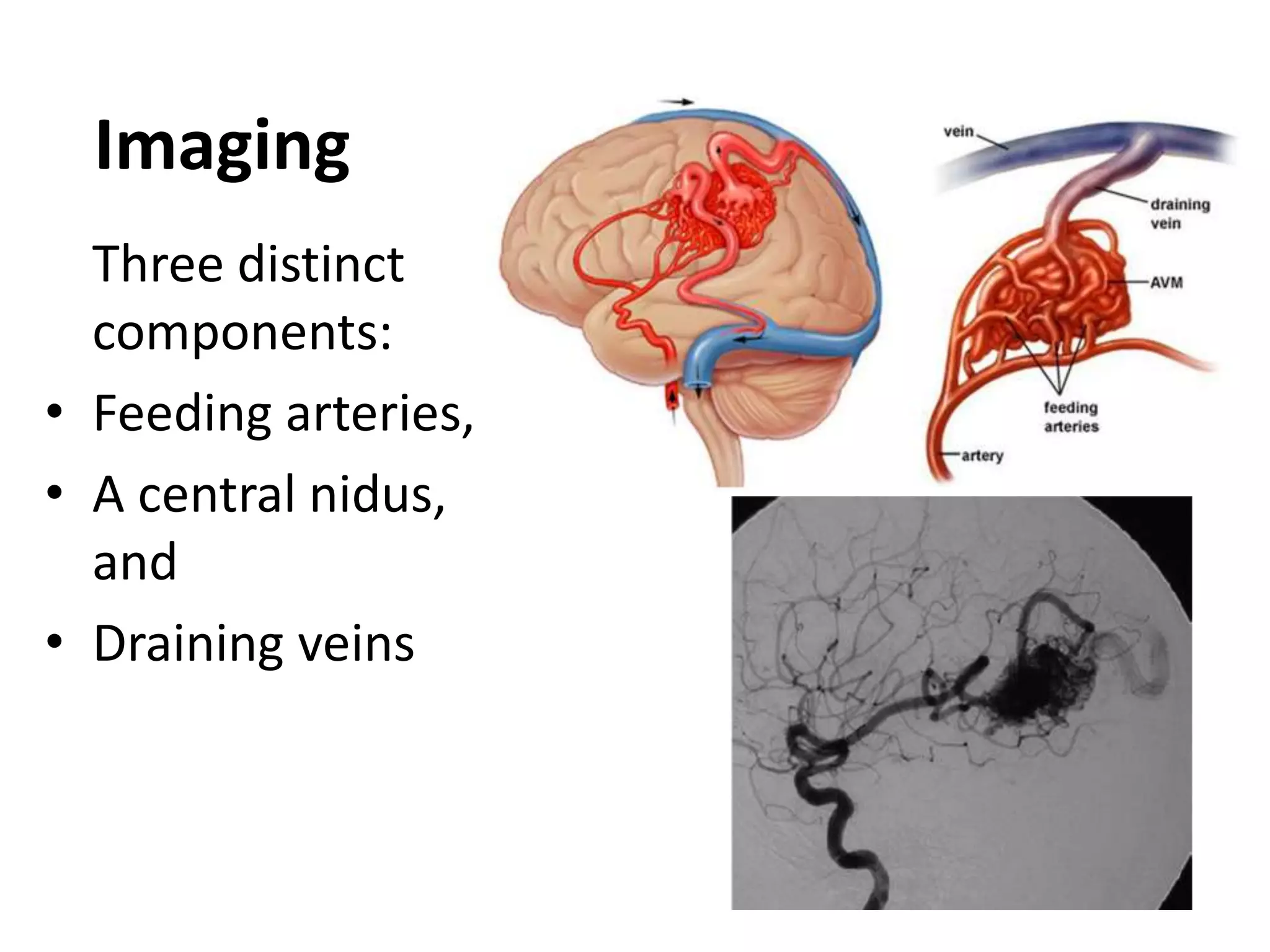 Intracranial vascular malformations | PPTX