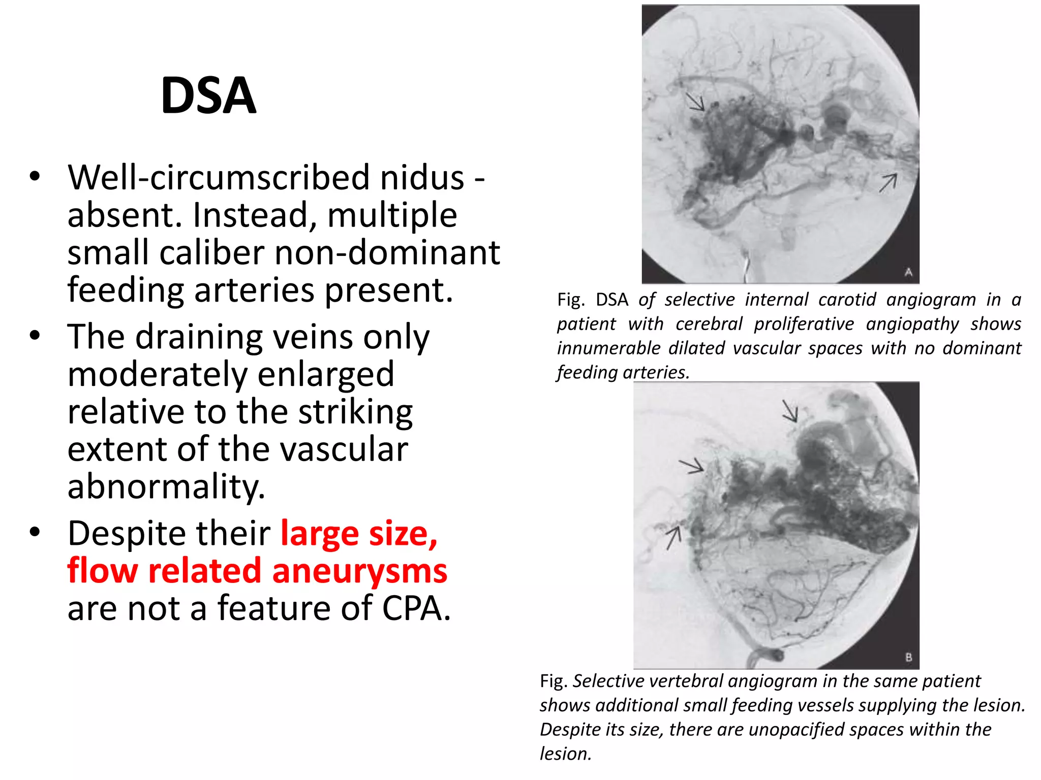 Intracranial vascular malformations | PPTX