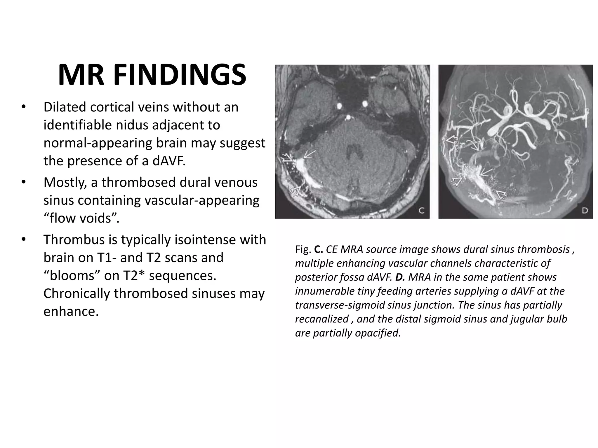 Intracranial vascular malformations | PPTX