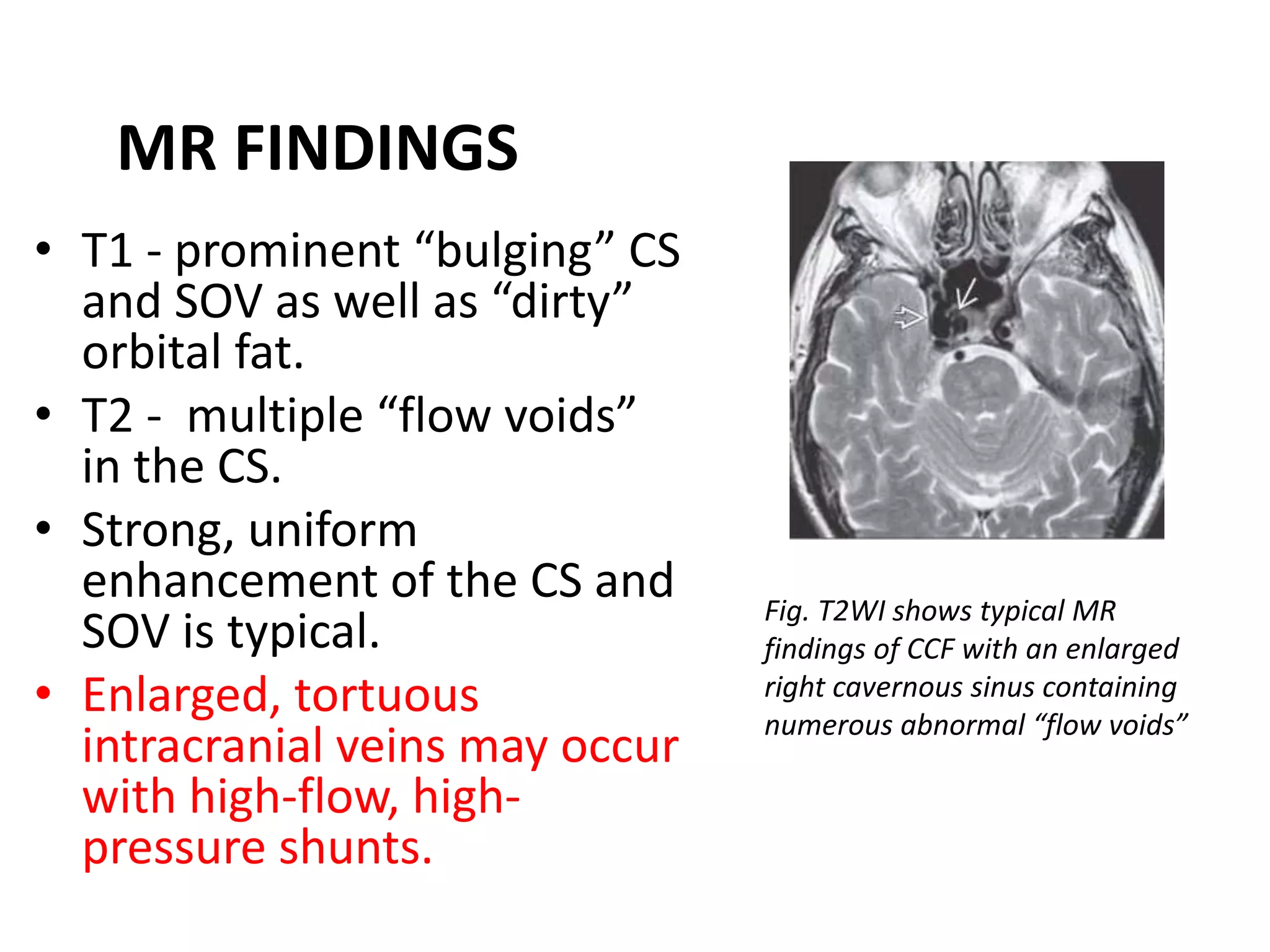 Intracranial vascular malformations | PPTX