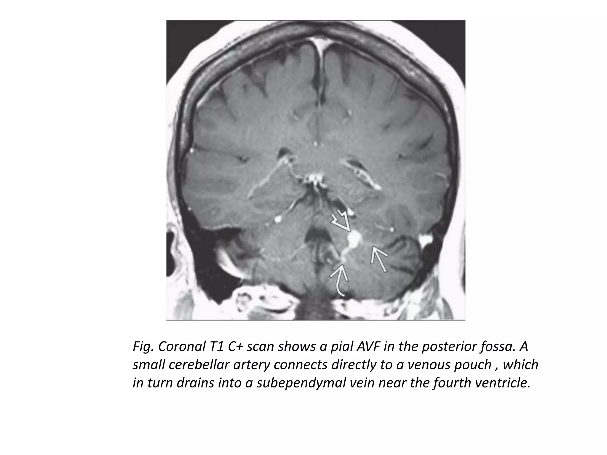 Intracranial vascular malformations | PPTX