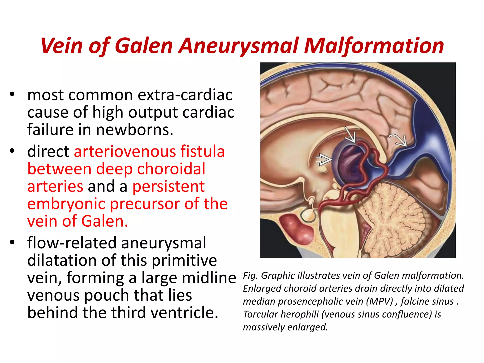 Intracranial vascular malformations | PPTX