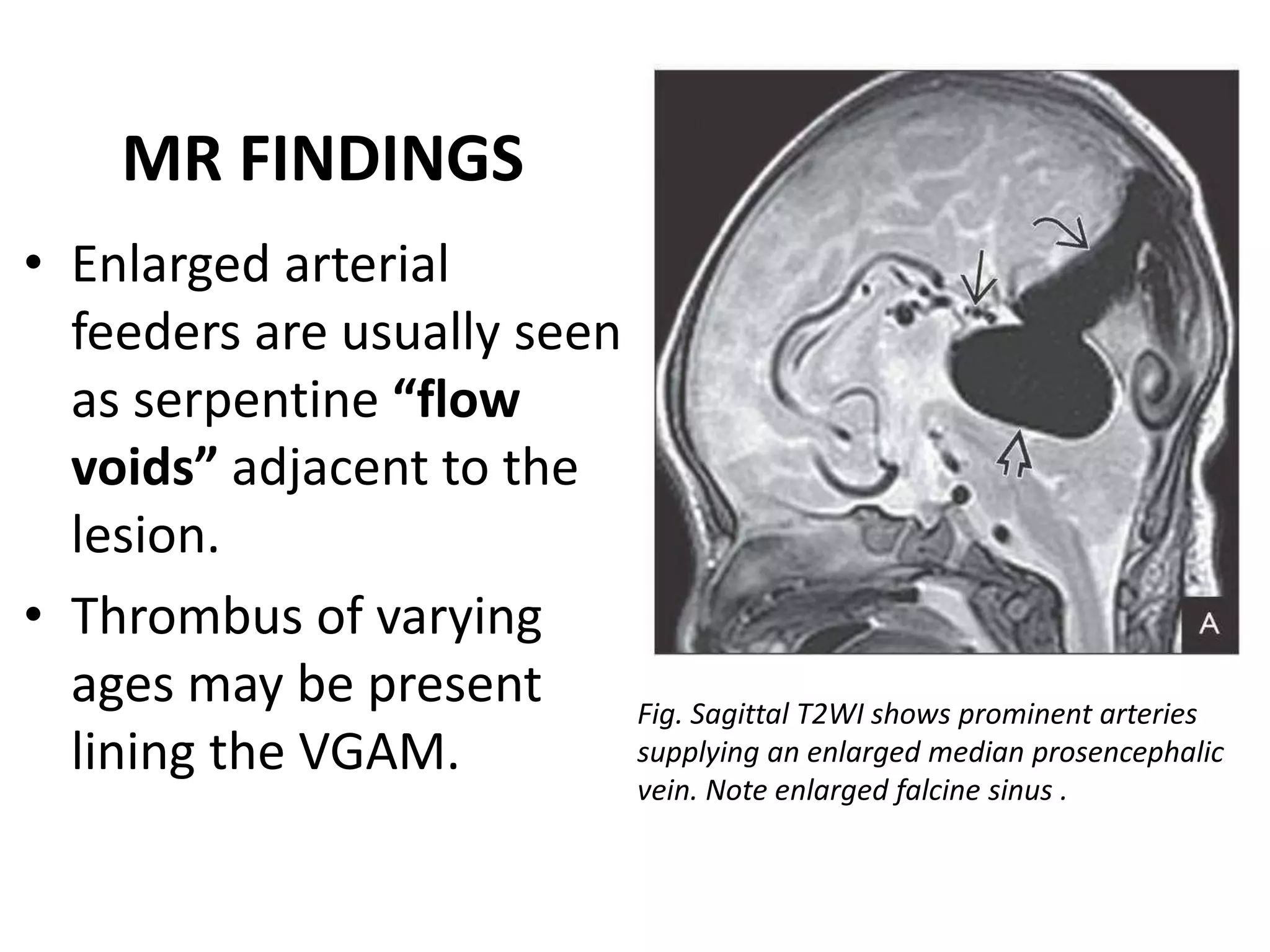 Intracranial vascular malformations | PPTX