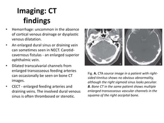 Nect Channel Intracranial vascular malformations | PPTX
