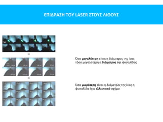 ΕΠΙΔΡΑΣΗ ΤΟΥ LASER ΣΤΟΥΣ ΛΙΘΟΥΣ
Όσο μεγαλύτερη είναι η διάμετρος της ίνας
τόσο μεγαλύτερη η διάμετρος της φυσαλίδας
Όσο μικρότερη είναι η διάμετρος της ίνας η
φυσαλίδα έχει ελλειπτικό σχήμα
 