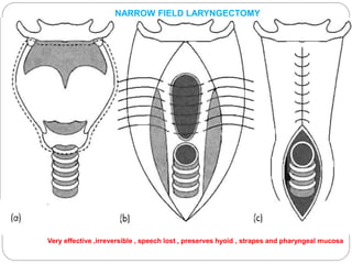 Very effective ,irreversible , speech lost , preserves hyoid , strapes and pharyngeal mucosa
NARROW FIELD LARYNGECTOMY
 